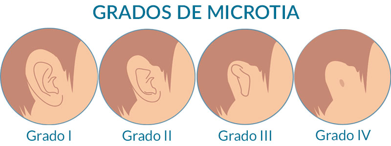 Microtia – PRIMER INSTITUTO AUDITIVO DEL PARAGUAY